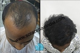 Before After
